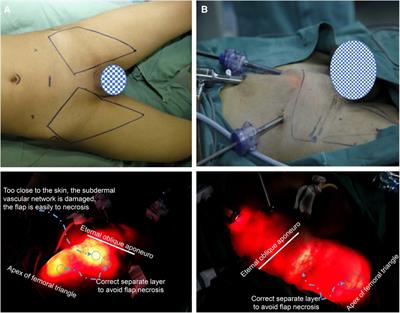 Laparoscopic simultaneous anterograde inguinal and pelvic lymphadenectomy for penile cancer: two planses, three holes, and six steps